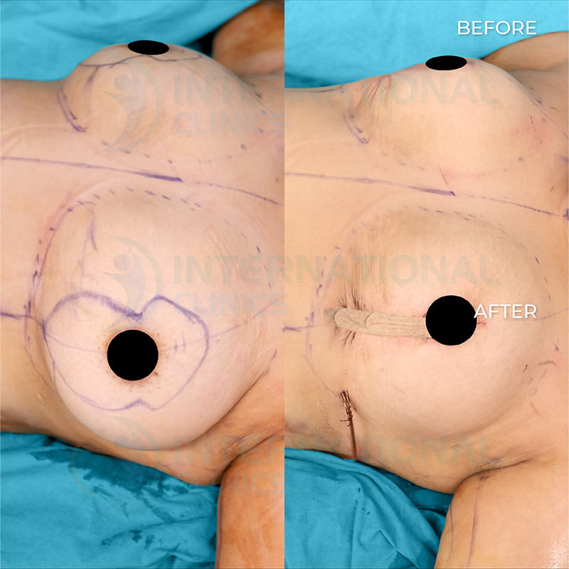 Breast Lift Before and After pictures